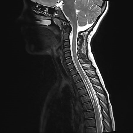 Case Study: Chiari Malformations – a curious pathology - Briz Brain & Spine